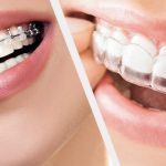 أنواع وفوائد تقويم اسنان في مجمع صحتي المتميز الطبي